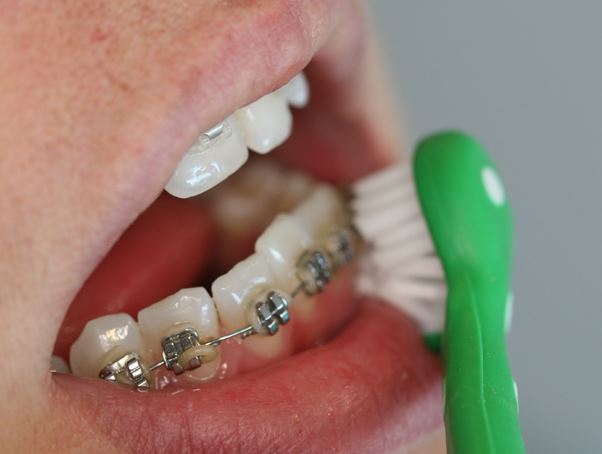 Surround Toothbrush Braces